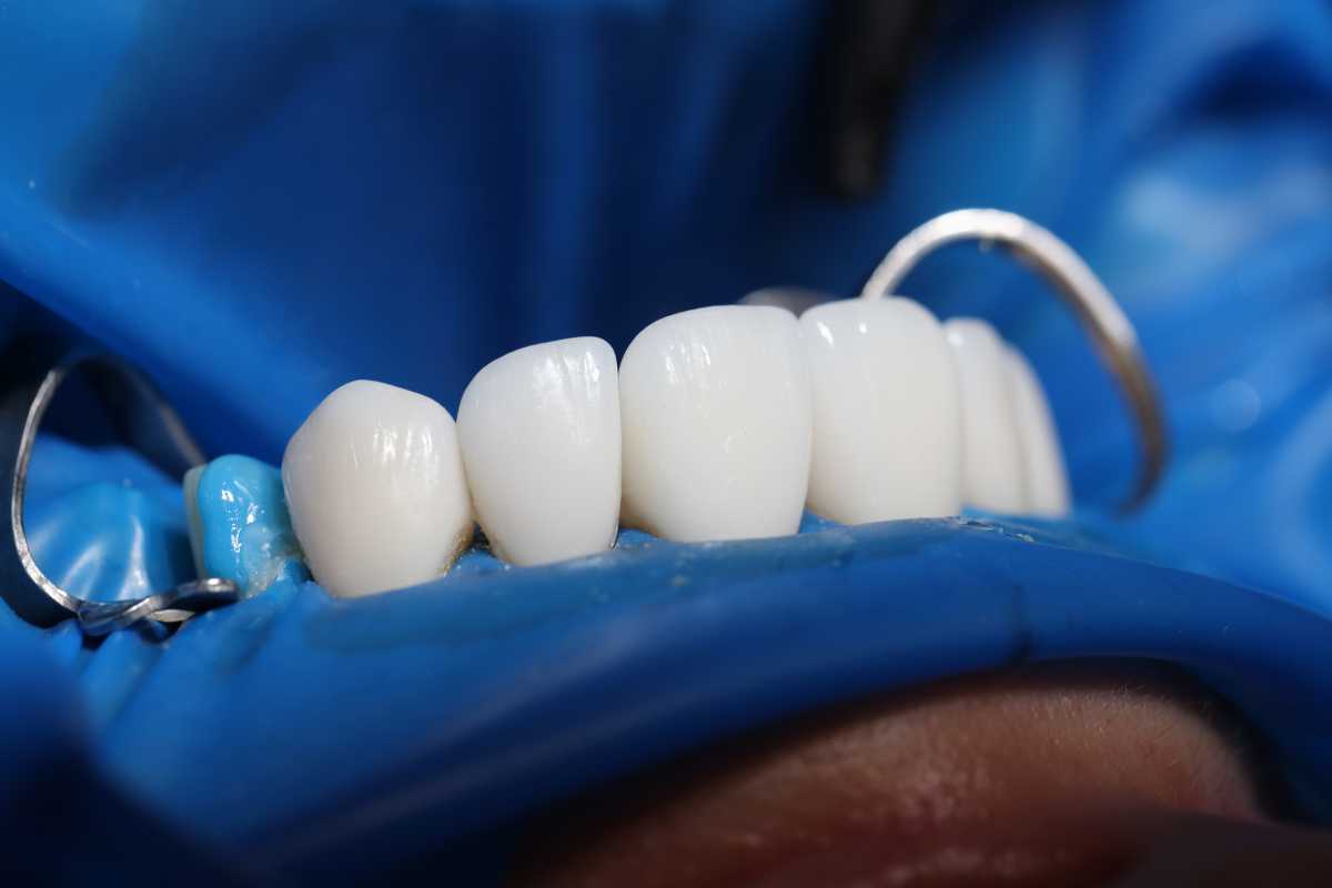 Prótesis removibles una solución versátil para la pérdida de dientes - CENTRO MIGUEL GONZÁLEZ