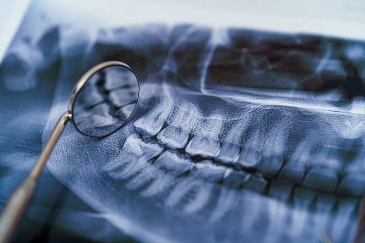 Tratamientos modernos para la pérdida ósea dental - CENTRO MIGUEL GONZÁLEZ
